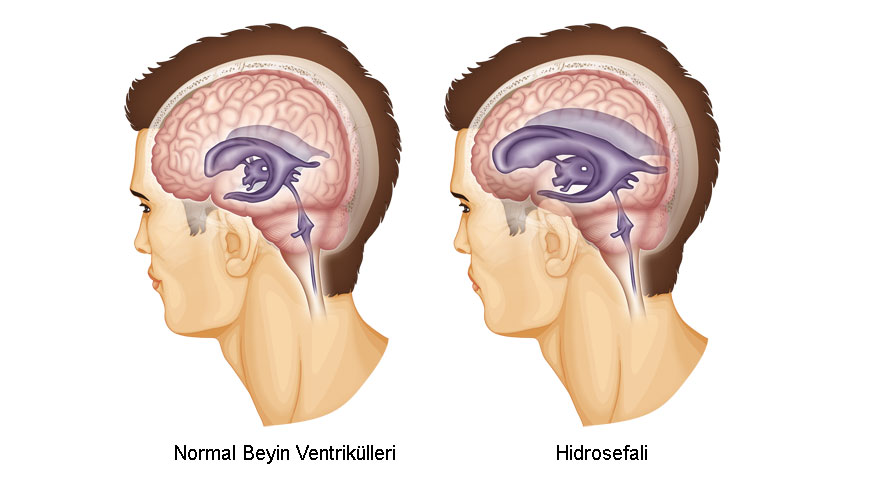 Hydrocephalus