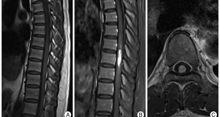 Lumbar Mass