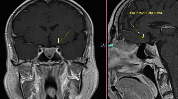 Pituitary Adenoma