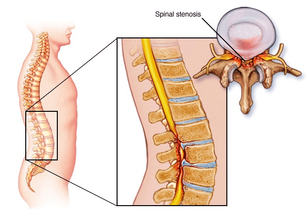 Spinal Canal Stenosis