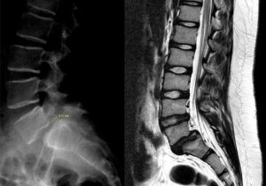 Spondylolisthesis (Waist Slip)